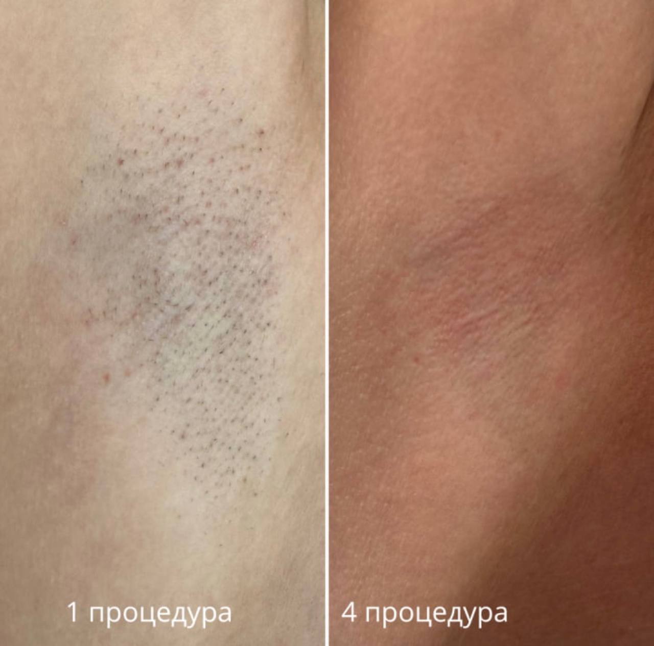 Результат лазерной эпиляции — подмышки