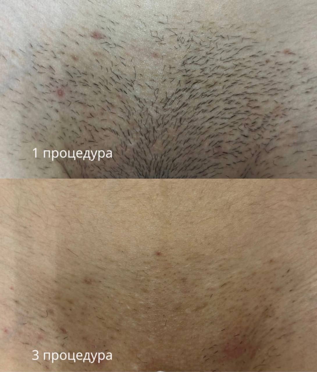 Результат лазерной эпиляции — ноги
