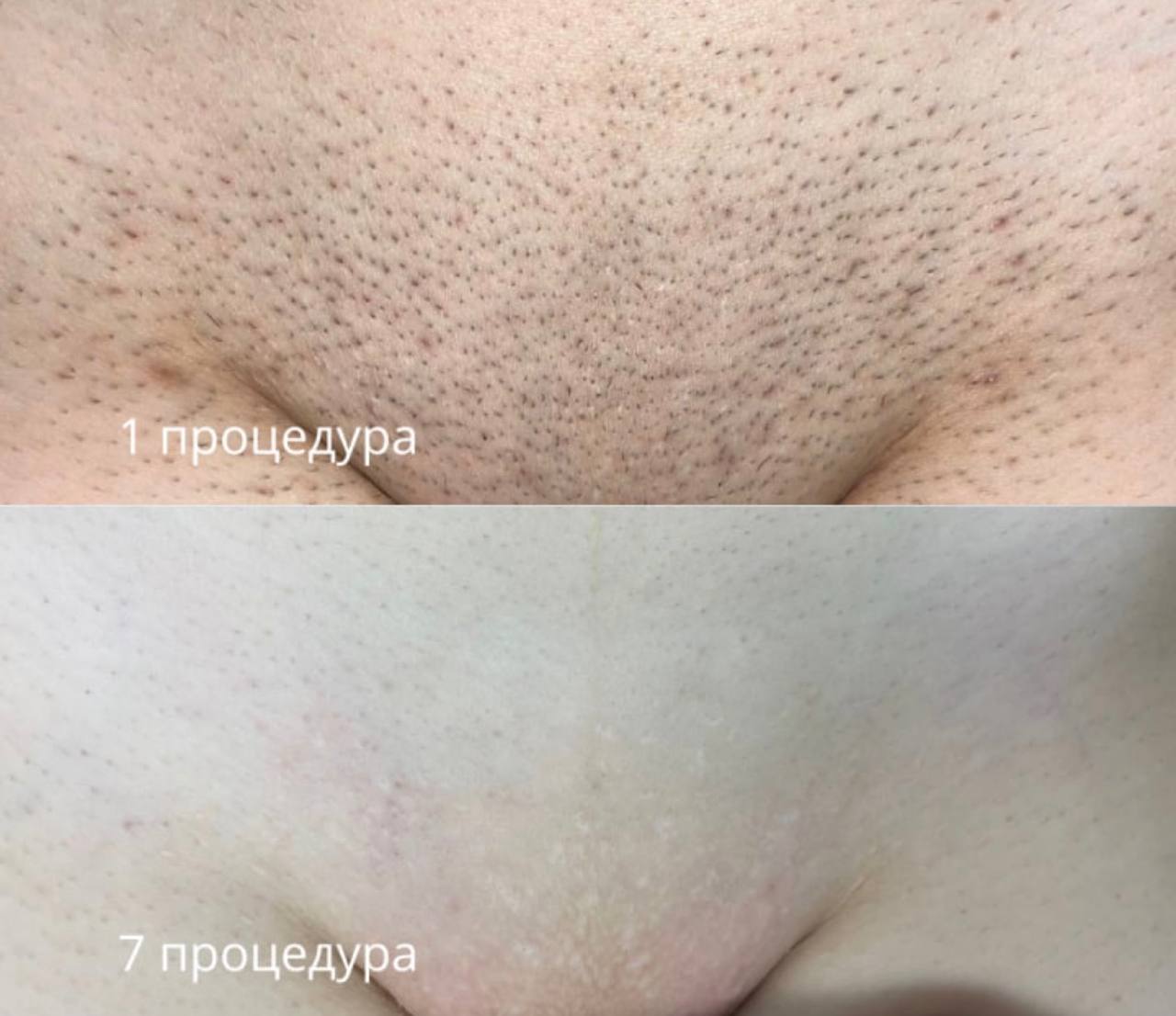Результат — шугаринг бикини